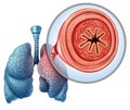 COPD chronic obstructive pulmonary disease Royalty Free Stock Photo