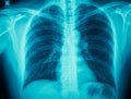 Copd Royalty Free Stock Photo