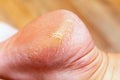 Corn callus cracks on a sole heel foot close up. Dry skin dermatology problem Royalty Free Stock Photo