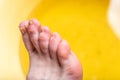 Corn or clavus on female foot. Royalty Free Stock Photo