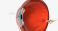 A corneal abrasion, or scratch, is a shallow injury to the surface of the cornea