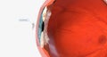 A corneal abrasion, or scratch, is a shallow injury to the surface of the cornea