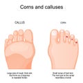 Corns on toe and calluses on sole