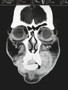 Coronal CT Scan of the Sinuses and Face Royalty Free Stock Photo