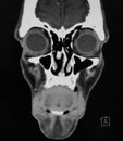 Coronal CT Scan of the Sinuses and Face Royalty Free Stock Photo