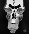 Coronal CT Scan of the Sinuses and Face Royalty Free Stock Photo
