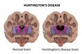 Coronal section of a brain of a person with Huntington`s disease