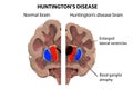 Coronal section of a brain of a person with Huntington`s disease