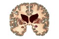 Coronal section of a brain of a person with Huntington's disease