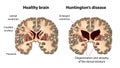 Coronal sections of a healthy brain and a brain in Huntington's disease