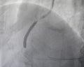 Coronary angiogram , medical x-ray