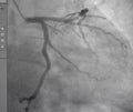 Coronary angiogram , medical x-ray Royalty Free Stock Photo