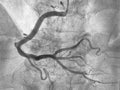 Coronary angiogram