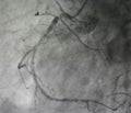 Coronary angiogram , medical x-ray Royalty Free Stock Photo