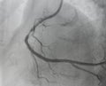 Coronary angiogram , medical x-ray