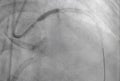 Coronary angiogram , medical x-ray