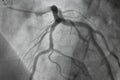 Coronary angiography, Coronary artery disease.