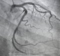 Coronary angiography. left coronary angiography.