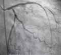 Coronary angiography , left coronary angiography.