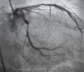 Coronary angiography. left coronary angiography.