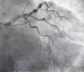 Coronary angiography. left coronary angiography.