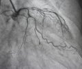 Coronary angiography. left coronary angiography.