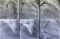 Coronary angiogram. medical x-ray