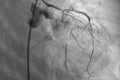 Coronary angiography , left coronary angiography