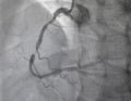 Coronary angiography. Medical x-ray.