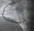 Coronary angiography , right coronary angiography. Royalty Free Stock Photo