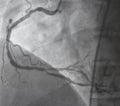 Coronary angiography.right coronary angiography.