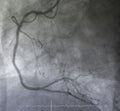 Coronary angiography.right coronary angiography.