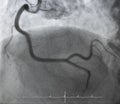 Coronary angiography.right coronary angiography.