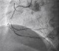 Coronary angiography.right coronary angiography.