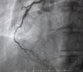 Coronary angiography.right coronary angiography.