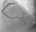 Coronary angiography.right coronary angiography.