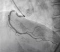 Coronary angiography. x-ray image.