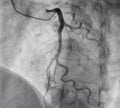 Coronary angiography. x-ray image.