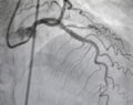 Coronary angiography. x-ray image.