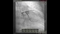 Coronary Angioplasty Stent Video