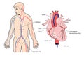 Coronary artery catheter