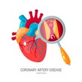 Coronary artery disease concept in flat style Royalty Free Stock Photo