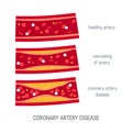 Coronary artery disease concept in flat style Royalty Free Stock Photo