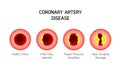 Coronary Artery Disease info graphic. Heart awareness concept. Royalty Free Stock Photo