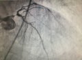 Coronary artery disease Tripple vessle disease with left main severe coronary stenosis bifurcation disease leftmain