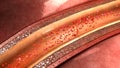 Coronary artery plaque