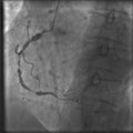 Coronary artery stenosis on angiography