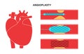 Angioplasty cardiac stent Royalty Free Stock Photo