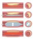 ballon implantation Royalty Free Stock Photo