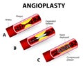 Coronary Balloon Angioplasty. Vector diagram Royalty Free Stock Photo